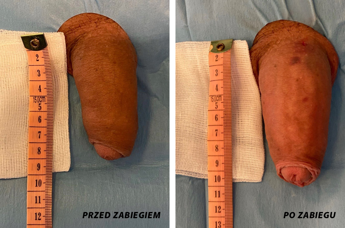 powiększanie penisa szczecin