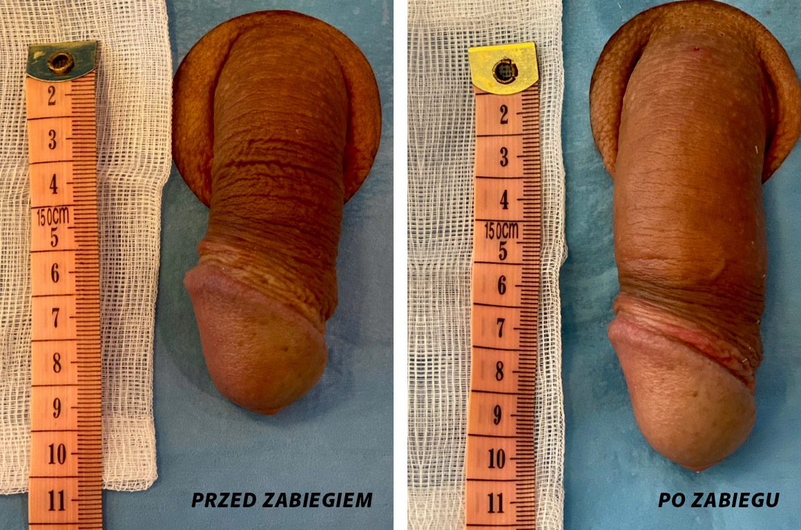 operacja zwiększona penisa przed i po