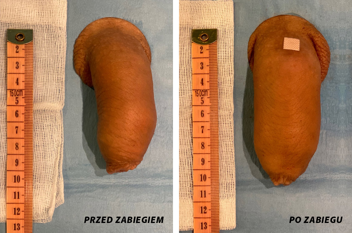 powiększanie penisa szczecin