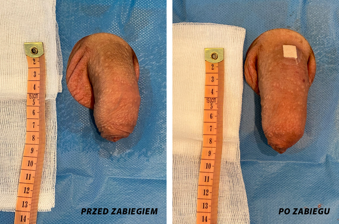 powiększanie penisa szczecin