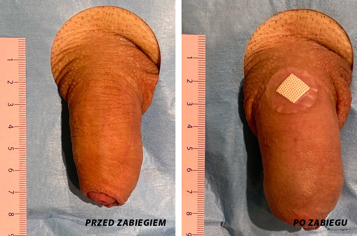 powiększanie penisa szczecin